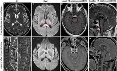 Autoimmune glial fibrillary acidic protein astrocytopathy coexistent with reversible splenial lesion syndrome: A case report and literature review